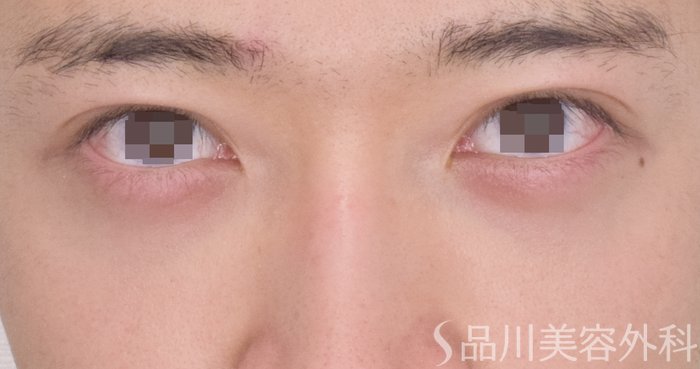 症例NO.64672のAFTER写真