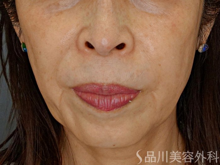 症例NO.74232のBEFORE写真