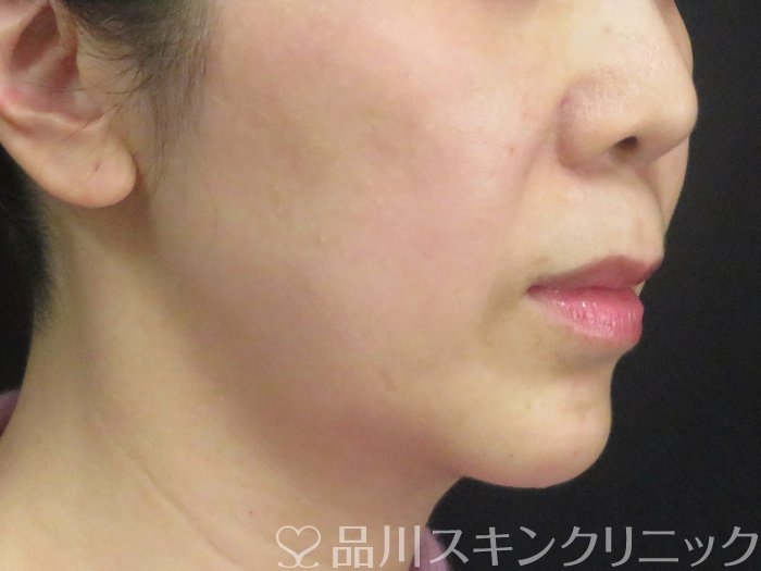 症例NO.67637のBEFORE写真