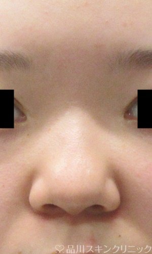 症例NO.65649のBEFORE写真