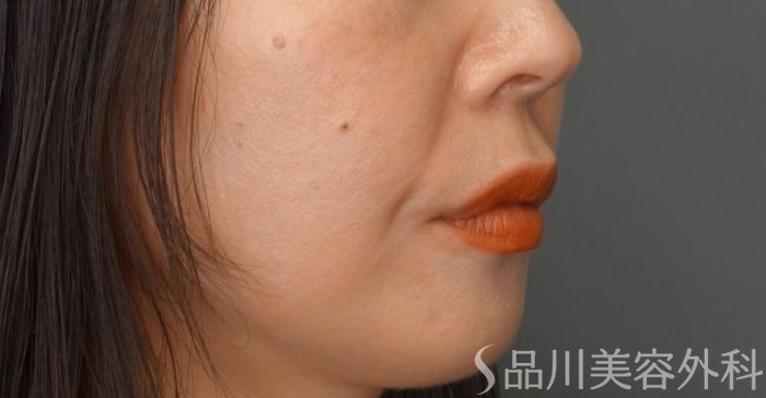 症例NO.65070のBEFORE写真