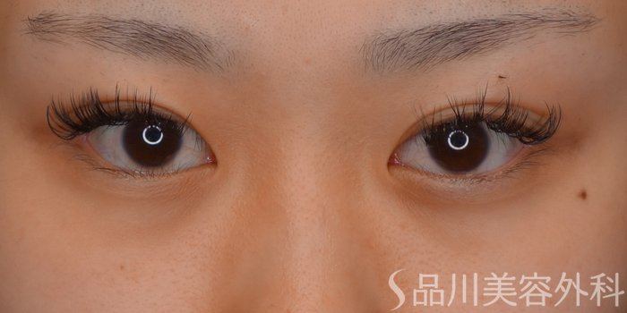 症例NO.73515のBEFORE写真