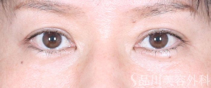 症例NO.72751のAFTER写真