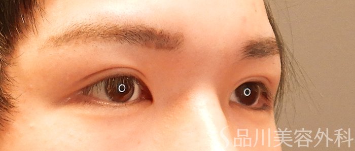 症例NO.70500のAFTER写真