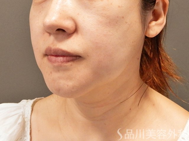 症例NO.70932のBEFORE写真