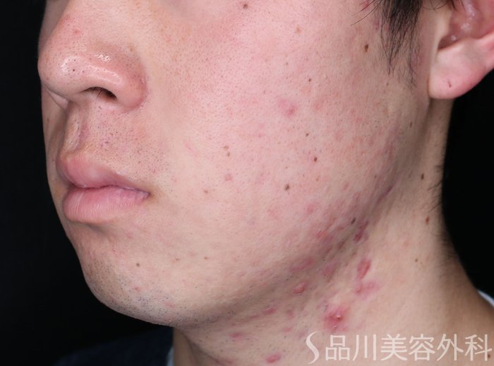 症例NO.68034のBEFORE写真
