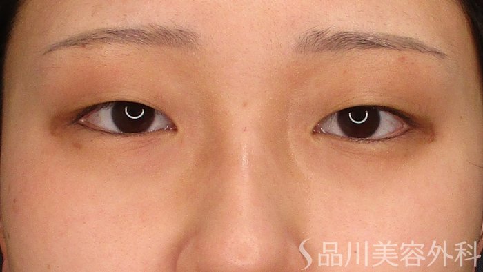 症例NO.69412のBEFORE写真