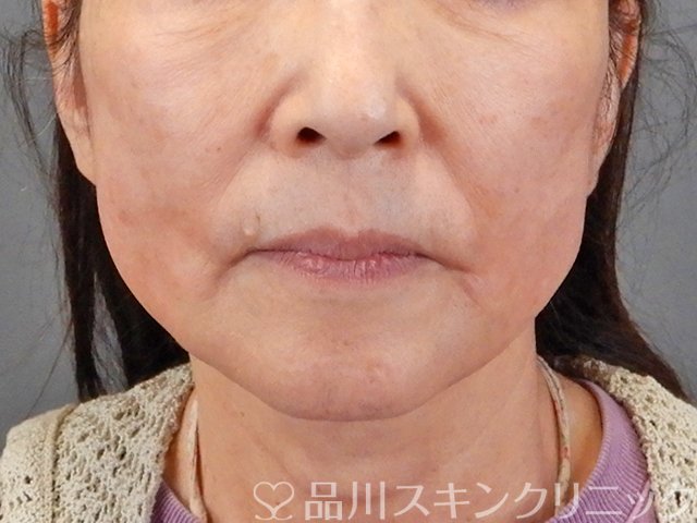 症例NO.75299のAFTER写真