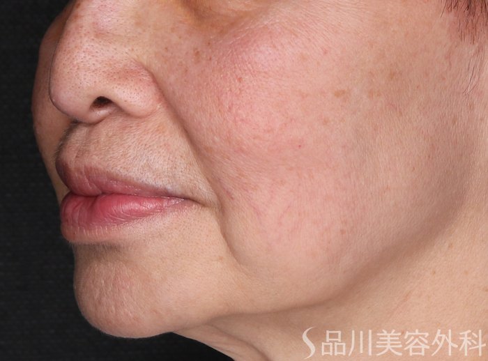 症例NO.70590のBEFORE写真