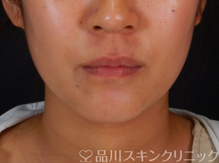 症例NO.65842のAFTER写真