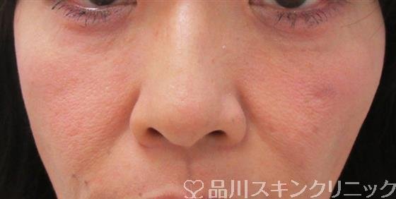 症例NO.30984のBEFORE写真