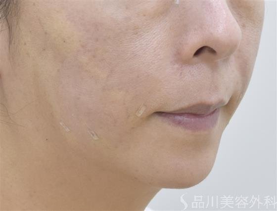 症例NO.48021のAFTER写真