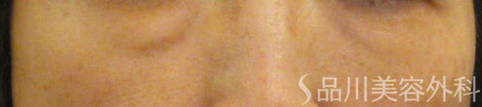 症例NO.72100のBEFORE写真