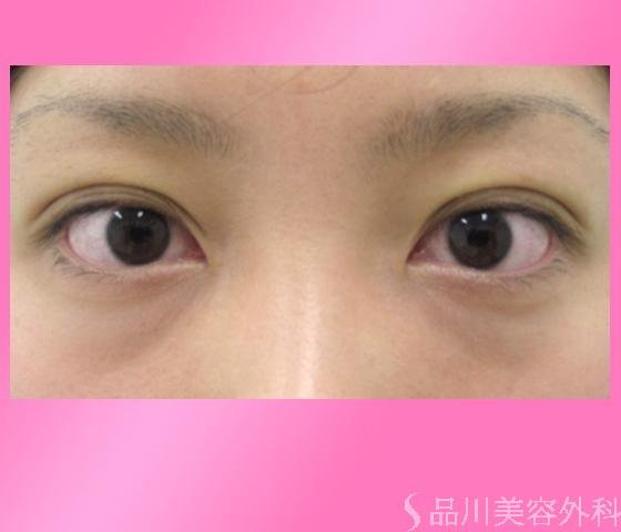 症例NO.1758のAFTER写真
