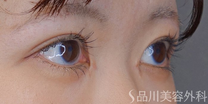症例NO.71658のAFTER写真