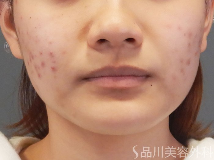 症例NO.72102のBEFORE写真