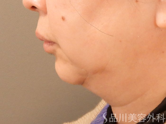 症例NO.70795のBEFORE写真
