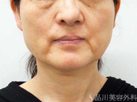 症例NO.53453のBEFORE写真