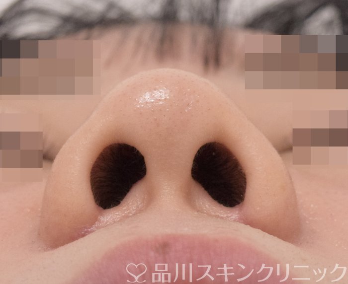 症例NO.71736のAFTER写真