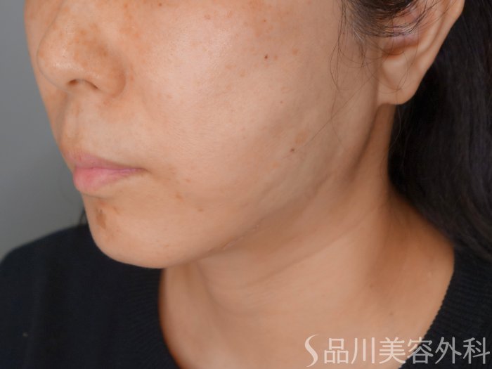 症例NO.70608のAFTER写真