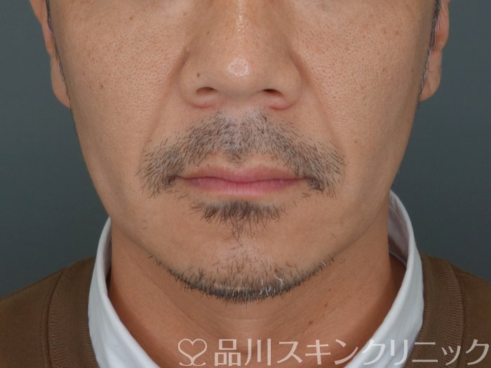 症例NO.72921のBEFORE写真