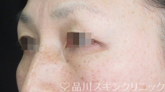 症例NO.69492のBEFORE写真