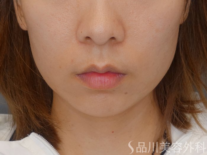 症例NO.71801のBEFORE写真