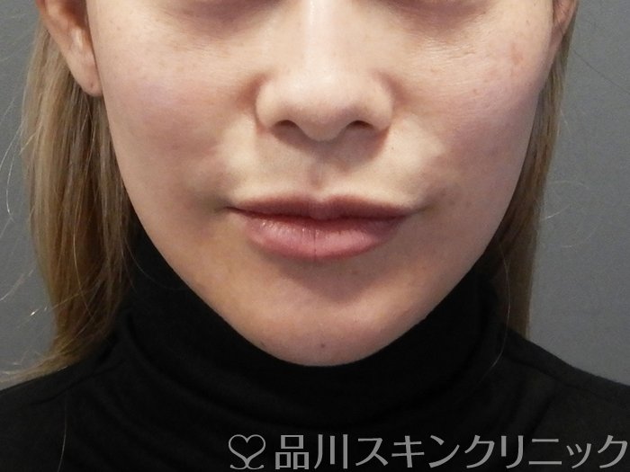 症例NO.72852のAFTER写真