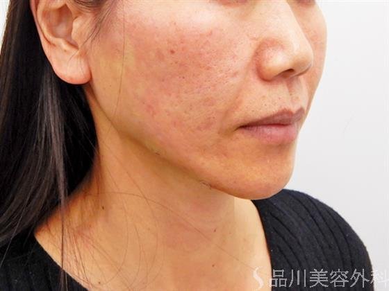 症例NO.53497のAFTER写真
