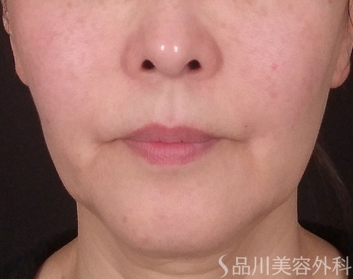 症例NO.69453のBEFORE写真