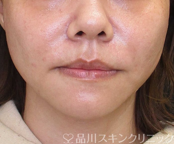 症例NO.65388のAFTER写真