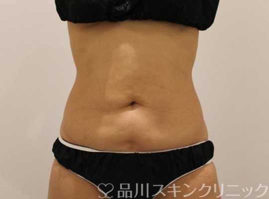 症例NO.69238のBEFORE写真