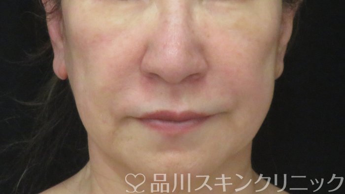 症例NO.71887のBEFORE写真