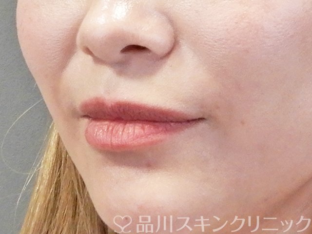 症例NO.67708のBEFORE写真