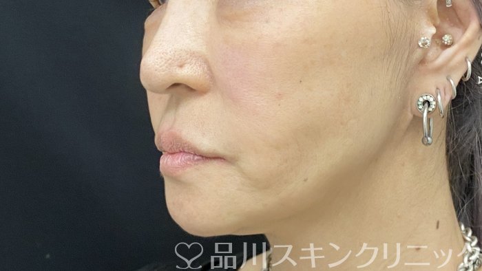 症例NO.74504のAFTER写真