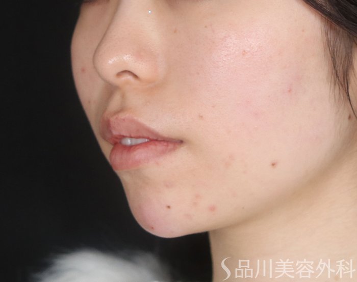 症例NO.73192のAFTER写真