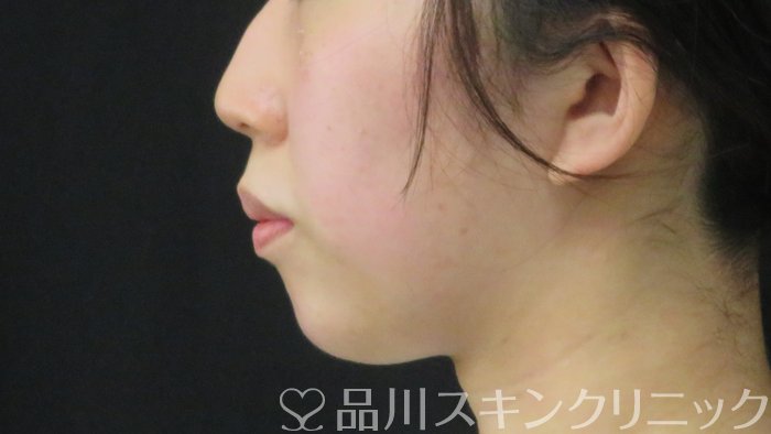 症例NO.72117のAFTER写真