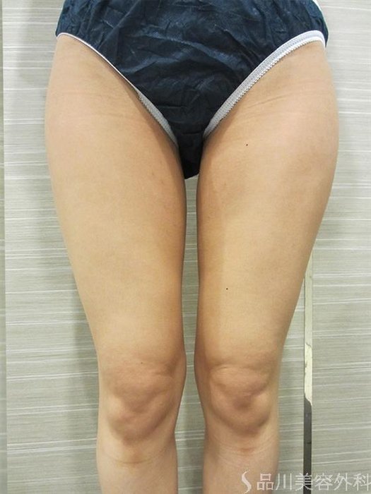 症例NO.22633のAFTER写真