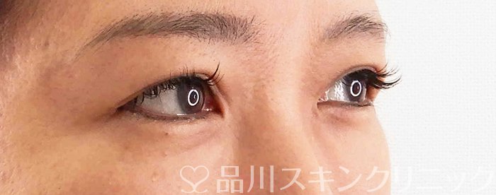症例NO.67862のBEFORE写真