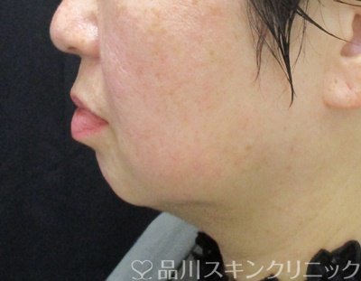 症例NO.69884のBEFORE写真