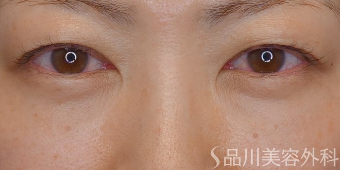 症例NO.72943のAFTER写真