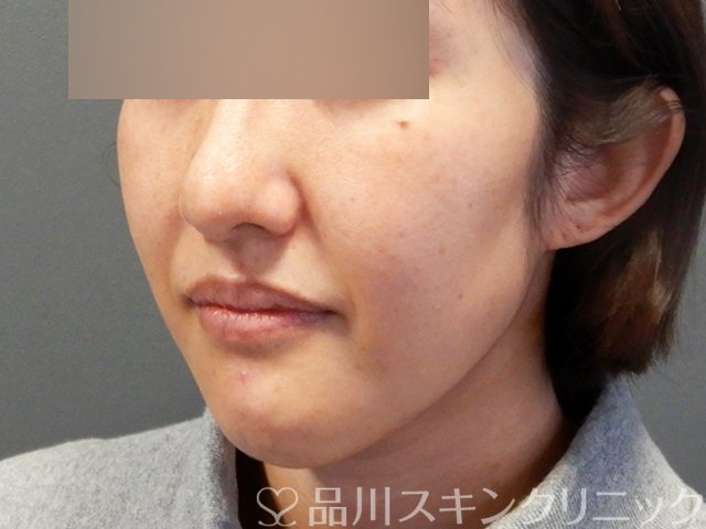 症例NO.69181のBEFORE写真