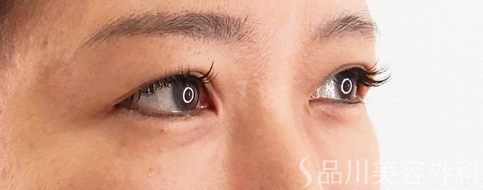 症例NO.67862のBEFORE写真