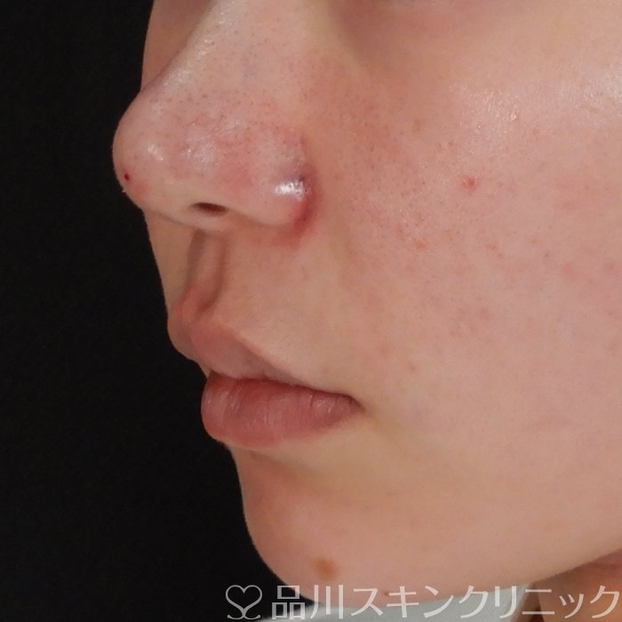 症例NO.63105のAFTER写真