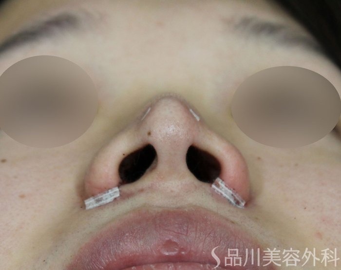 症例NO.72049のAFTER写真