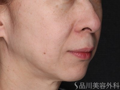 症例NO.72700のAFTER写真