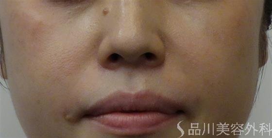 症例NO.52017のAFTER写真