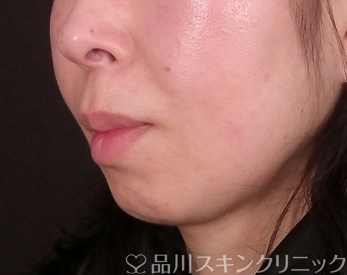 症例NO.69647のAFTER写真