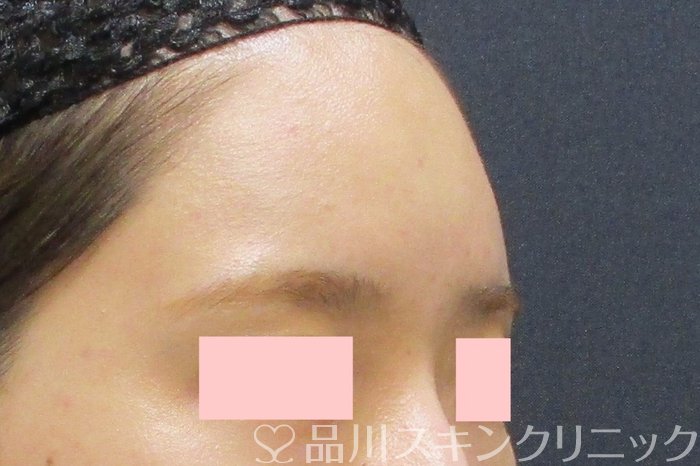 症例NO.69554のAFTER写真