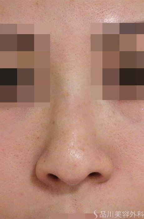 症例NO.47082のBEFORE写真